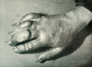 Main gelée du Dr Atkinson, 5 juillet 1911, 1913