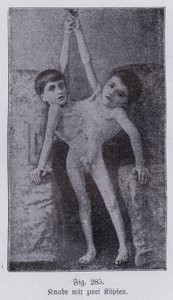 Giacomo et Giovanni Battista Tocci, jumeaux siamois italiens
