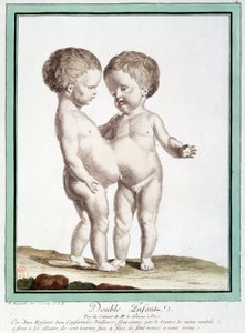 Enfants siamois - dans « Les déviations de la nature » par Régnault