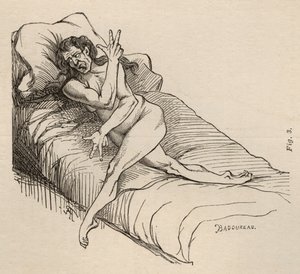 Épilepsie hystérique, attaque, contorsions, fig. 3 de 