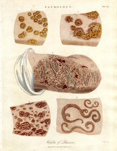 Modifications pathologiques de la peau : Variétés de psoriasis - John Pass