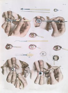 Opération sur un œil, planche de 