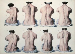 Déformations de la colonne vertébrale, planche de 