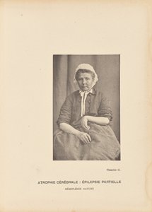 Atrophie Cérébrale: Épilepsie Partielle Hémiplégie Gauche - Paul Marie Léon Regnard