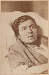Épilepsie hystérique, contraction du visage, planche VIII de 