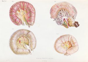 Surface externe des intestins infectés par le choléra, de Anatomie Pathologique du Cholera Morbus, par Nikolai Ivanovich Pirogov, publié à Saint-Pétersbourg, 1849