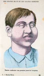 Victime de la variole, vers 1890 - Unbekannt