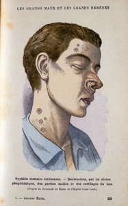 Symptômes de la phase tertiaire de la syphilis, 19ème siècle - Unbekannt