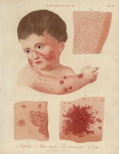 Maladies de la peau des nourrissons - Unbekannter Künstler