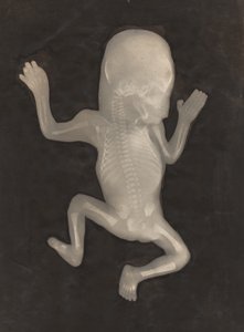 Degree of Ossification of a Five-Month-Old Fetus (Degré d