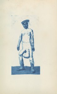 Éléphantiasis - Unknown 19th Century