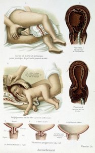 Accouchement - planche scientifique, fin XIXe siècle - Unknown artist