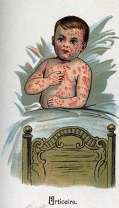 Maladies infantiles : Urticaire. dans « La nouvelle médecine naturelle » par F.E. Bilz - Unknown artist