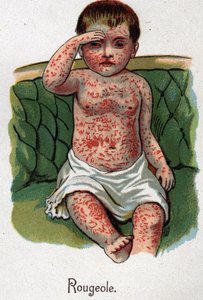 Maladies infantiles : Rougeole. Dans « La nouvelle médecine naturelle » par F.E. Bilz. - Unknown artist