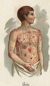 Maladies infantiles : La gale. Dans « La nouvelle médication naturelle » de F.E. Bilz - Unknown artist