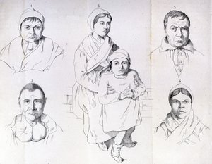 Considérations sur les causes du crétinisme endémique par Morel. - Unknown artist