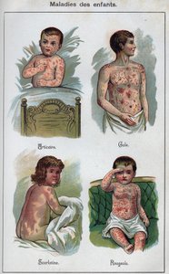 Maladies des enfants : Urticaire, Rougeole, gale, scarlatine. Dans "La nouvelle médication naturelle" de F.E. Bilz - Unknown artist