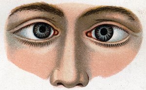Strabisme convergent. « La nouvelle médication naturelle » de F.E. Bilz.