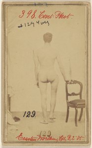 Fracture du tiers supérieur du fémur. Erastus Worthen, Corp Co. B. 2nd Vermont Vols. 25 ans - Domicile Stockbridge VT.