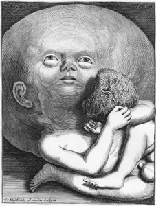 Monstre : Enfant hydrocéphale anthropologie - gravure, n.d., fin XVIIIe siècle - Unknown artist