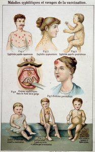 Planche illustrant les différentes formes de maladies syphilitiques et les dangers de la vaccination - dans « Bilz, Médication naturelle », fin du 19e siècle - Unknown artist