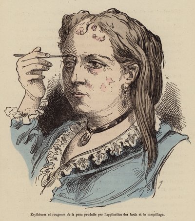 Femme avec des éruptions cutanées et des rougeurs causées par l