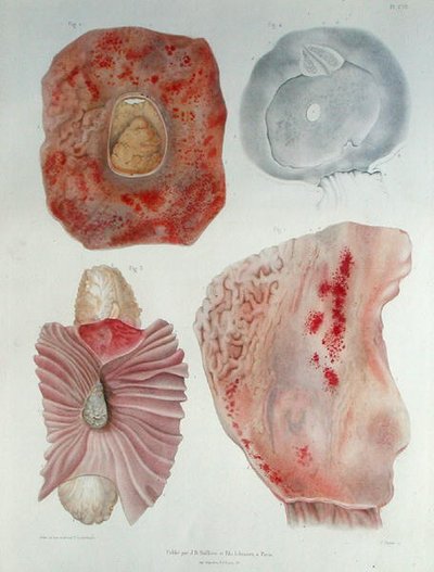 Organes infectés par le choléra, du 