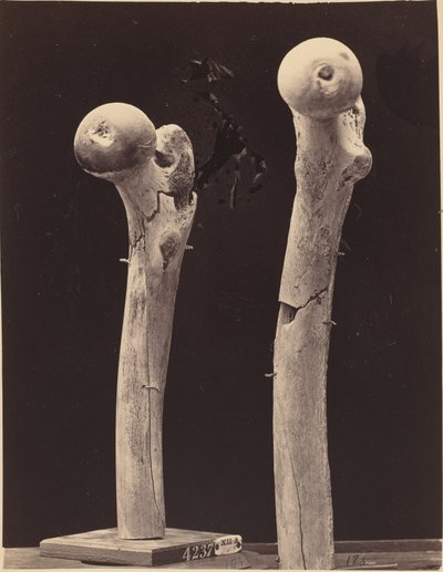 Spécimens de fractures par balle du fémur - American 19th Century