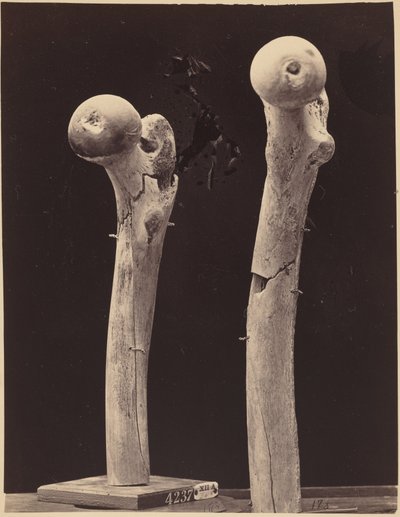 Spécimens de fractures du fémur par balle, c. 1867 (photo) - American Photographer