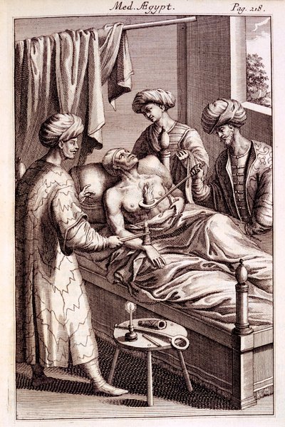 Illustration de la moxibustion de Medicina Aegyptorum par Prospero Alpinus, 1745 - American School