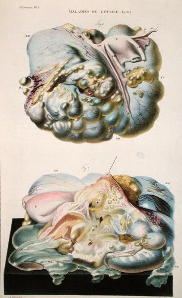 Maladies des ovaires, de 