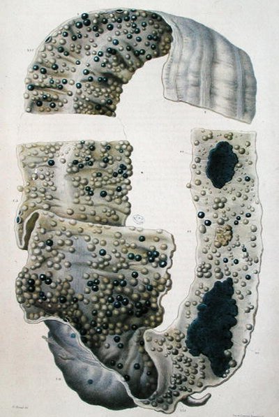 Maladies des intestins, de 