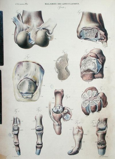 Maladies des Articulations, de 