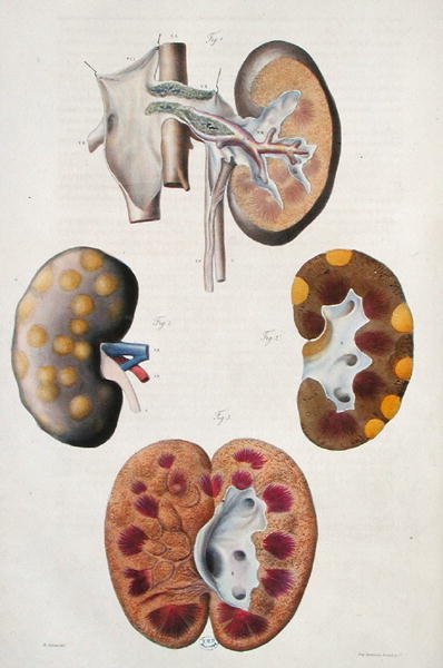 Maladies des Reins, de 