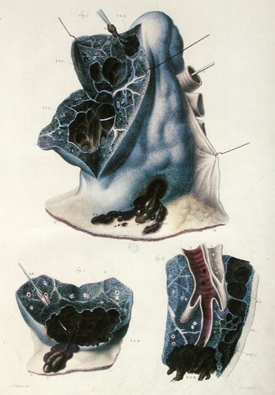 Maladies des poumons, de 