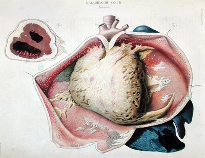 Péricardite, planche représentant des maladies cardiaques de 