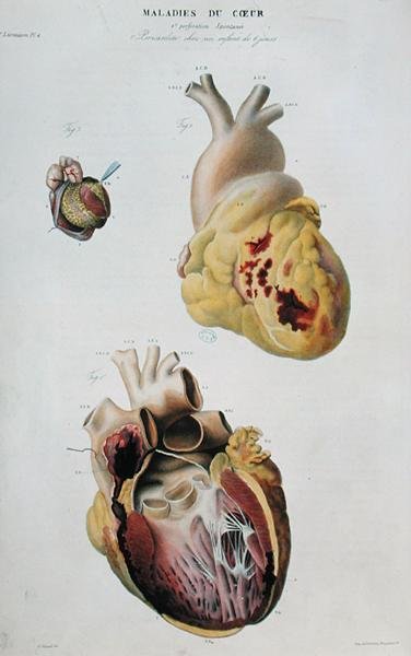 Planche représentant des maladies cardiaques. Rupture spontanée du cœur d