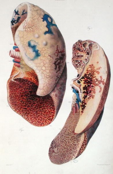 Pneumonie, de 