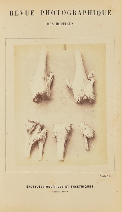 Exostoses multiples et symétriques, fémur, tibia - Arthur de Montmeja