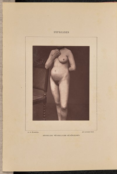 Syphilide vésiculeuse généralisée - Arthur de Montmeja