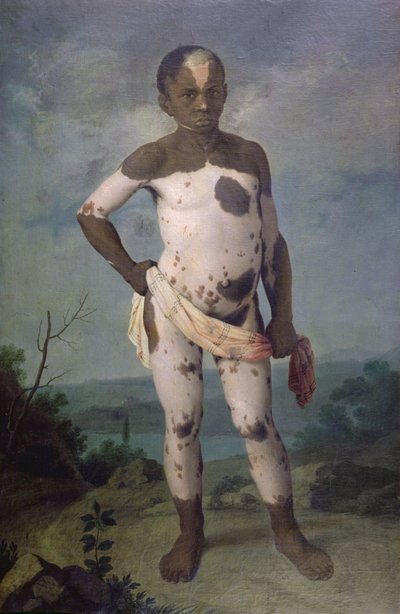 Enfant avec vitiligo, 1786 - Brazilian School