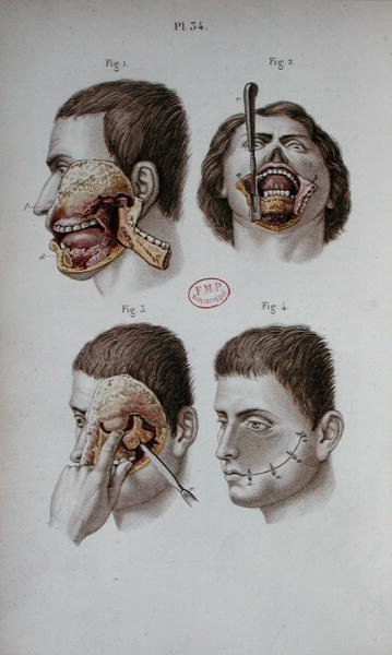 Planche anatomique de la mâchoire supérieure - C and Huette E. Bernard