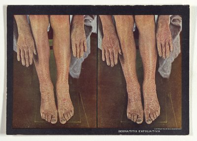 Dermatite exfoliante - Dr. Selden I. Rainforth