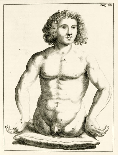 Exemple de malformations congénitales, de Exercitationes Practicae circa Medendi Methodum par Frederik Dekkers, 1694 - Dutch School