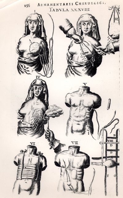 Opération sur un cancer du sein, de Armamentarii Chirurgici par Johannes Schultes (1595-1645) publié à Amsterdam, 1672 - Dutch School