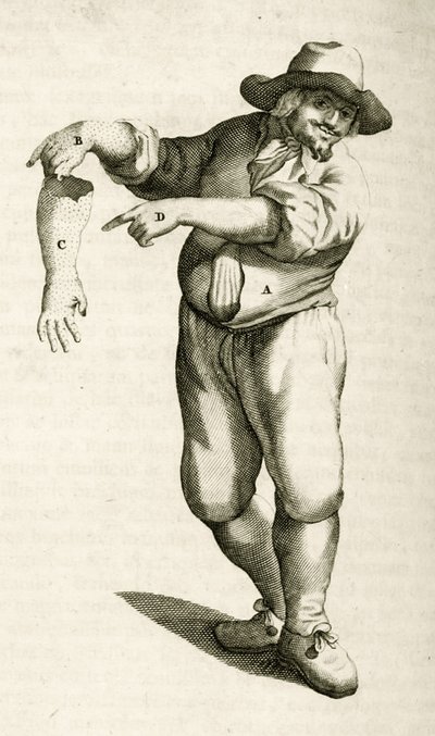 Retrait de la peau morte avec des pustules, de Exercitationes Practicae circa Medendi Methodum par Frederik Dekkers, 1694 - Dutch School
