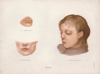 Maladies de la peau : Herpès - English School
