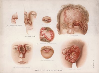 Maladies de la peau : ulcère rongeur et épithéliome - English School