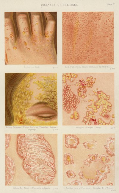 Maladies de la peau (lithographie en couleur) - English School