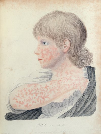 Rougeole allemande, illustration pour un livre de Robert Willan (1757-1812), 1808 (gravure en couleur) - English School
